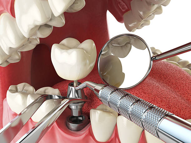 Best Emergency Root Canal Treatment in Whitfield, PA